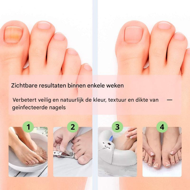 Laserapparaat voor het verwijderen van nagelschimmel